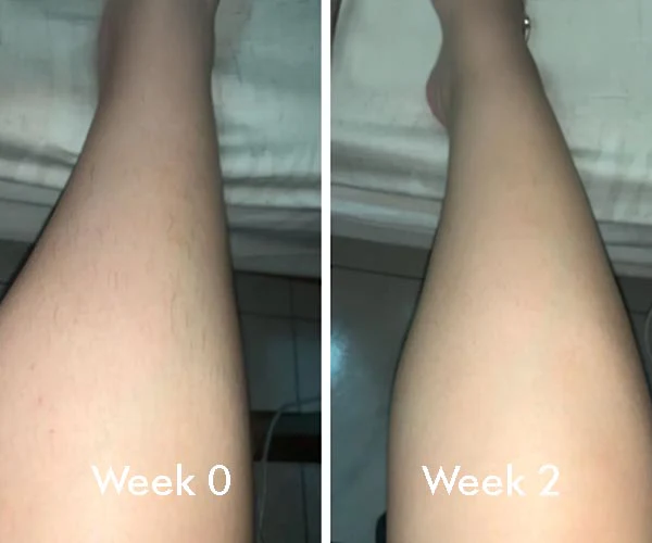 ELIXE IPL HAIR REMOVAL amazing opnion
