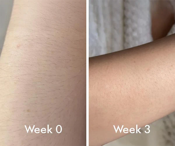 ELIXE IPL HAIR REMOVAL great