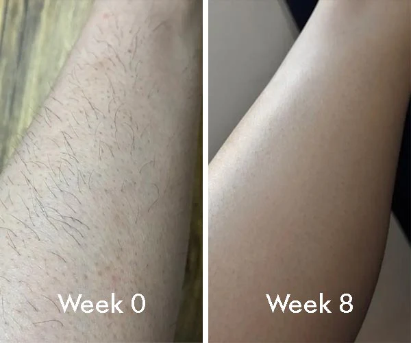 ELIXE IPL HAIR REMOVAL happier
